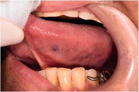 primary syphilis with a tongue ulcer