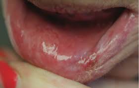 sore inside lower lip