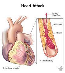 What Exactly Is A Heart Attack gambar png