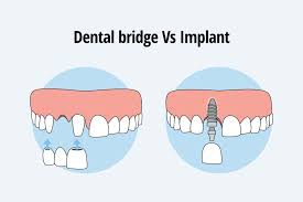 bridges vs implants which is the best