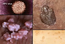 Genital Warts Hpv Picture Image On Medicinenet Com