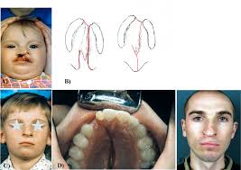 cleft lip and palate repair