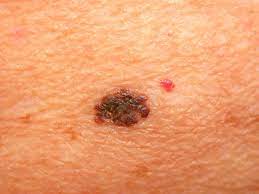 In general, a lower grade indicates a. Early Stage Melanoma Treatment Options