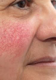 veins redness laser and skin