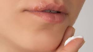 cold sores symptoms causes and