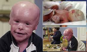 Harlequin fetus is a shock image which shows a baby with a rare skin disease with massive scales on the body which is reddish in color. Connecticut Boy Covered In Scales Must Have Them Scraped Off Body Twice A Day To Save Life Daily Mail Online