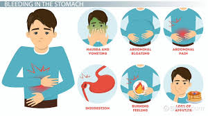 internal stomach bleeding causes