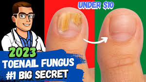 best toe nail fungus treatment 2023 4