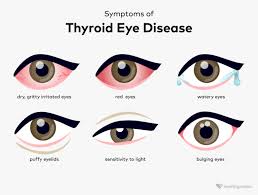 thyroid eye disease definition