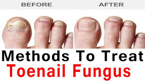 toenail fungus cation treatment