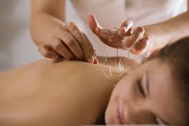 l acupuncture et la stimulation