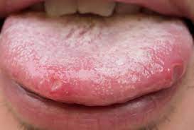sore tongue causes symptoms