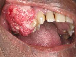 5 Common Oral Diseases In Nigeria: Causes, Symptoms & Treatment