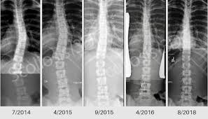 juvenile scoliosis early onset