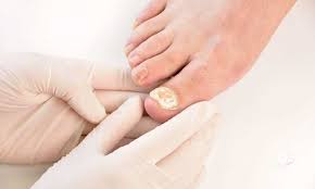 home remes to treat toenail fungus