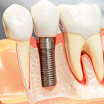 dental implant cost in delhi single