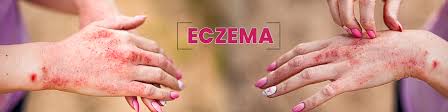 homeopathic treatment eczema