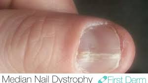 an nail dystrophy