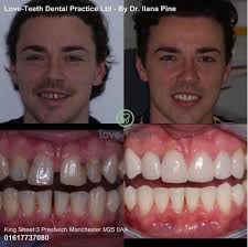 The customized mold covers the space perfectly. Dental Veneers And Composite Bonding Love Teeth Dental Practice Manchester Prestwich Salford