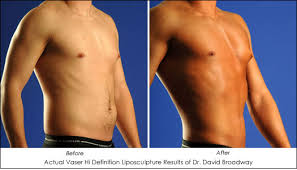 male body contouring sees rise in