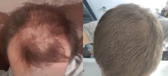 When trying to decide which hairstyle would go best with your receding hairline a barber or hair stylist will look at how your face, the shape of your head, whether it's oblong, round etc. How Often To Microneedle For Hair Loss It Depends Studies Photos