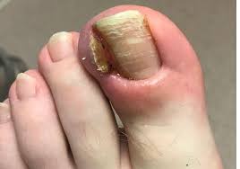 what is an ingrown toenail gentle