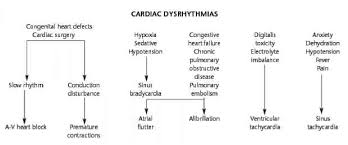 Flow Chart For Cardiac Dysrhythmias Pediatric Nursing
