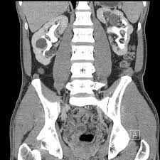 a 38 year old man with hydronephrosis