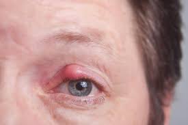 what is eye herpes symptoms treatment