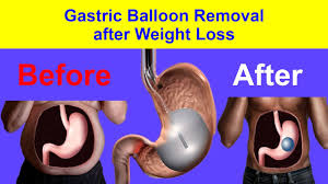 gastric balloon removal of gastric balloon after weight loss