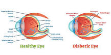 Image result for icd 10 code for proliferative diabetic retinopathy right eye
