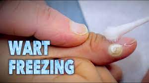 freezing warts with sizzling liquid
