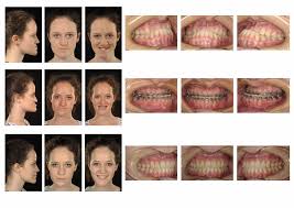 Surgery to correct an overbite involves disconnecting the upper jaw from the skull and moving it forward to bring it into alignment with the teeth of the lower jaw. Https Www Qvh Nhs Uk Wp Content Uploads 2015 09 A Guide For Pts Considering Orthognathic Surgery Rvw February 2020 Pdf