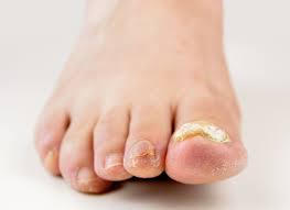 do you have thick discoloured toenails