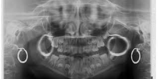 why remove jewellery for a cbct scan