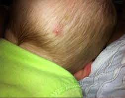 ingrown hair on head scalp pictures