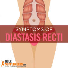 diastasis recti symptoms causes