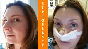 The medical dictionary cites the origin of the word septoplasty as septo, from latin sepes meaning hedge or wall to divide, and plasty meaning to mold, graft or form a specified part of the body. 59 Deviated Septum Ideas Septum Rhinoplasty Sinusitis