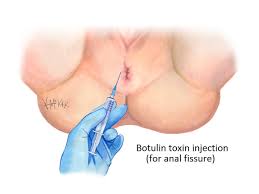 Botulinum Toxin Injections | Colorectal Surgeons Sydney