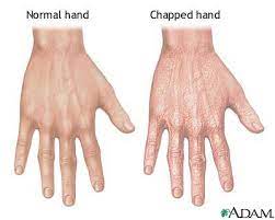 chapped hands medlineplus cal