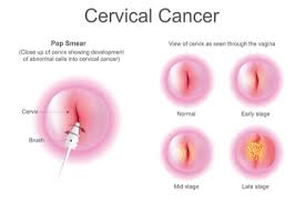 cervical cysts causes symptoms