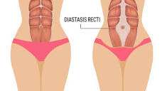 diastasis-recti-graphic - Elemental Esthetics