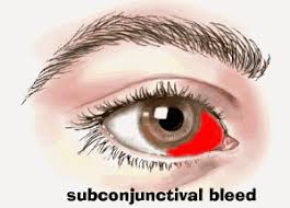 subconjunctival hemorrhage the eye center