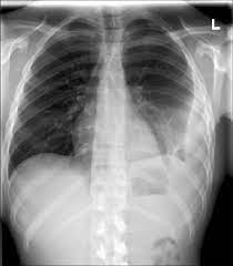 In our study loculated pleural effusion were seen in 8 patients, among which 6 cases were loculated tubercular effusion which were treated with steroids and 2 cases were loculated empyema of which. Chest Radiograph Showing A Left Sided Loculated Pleural Effusion Download Scientific Diagram