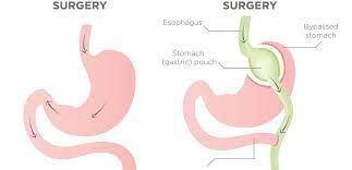 gastric byp surgery can it work