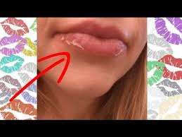 accutane side effects ling lips