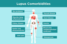 Borrowed from latin lupus (wolf). Lupus Complications What Lupus Patients Need To Know