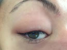 puffy swollen red eyelids how to