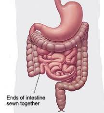 ileo caecal resection milton keynes