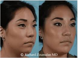 non surgical rhinoplasty beverly